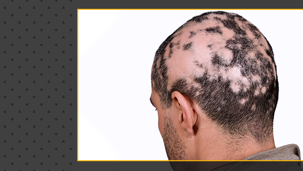 Alopecia tem cura? Tire suas dúvidas!